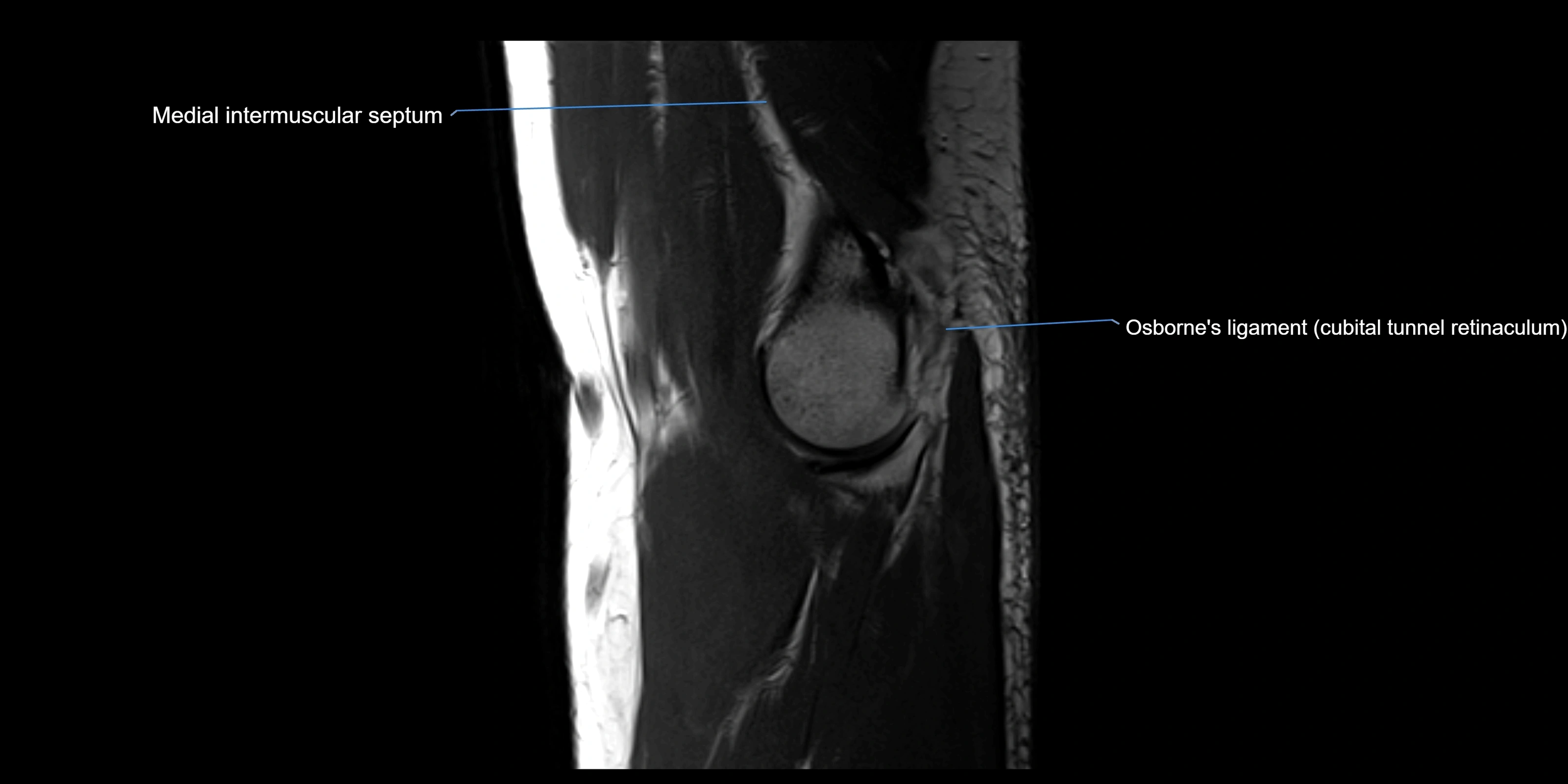 MRI elbow sagittal cross sectional anatomy 3T radiology  image-img-00001-00010.webp